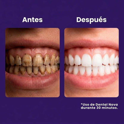 Tiras Blanqueadoras Estirables - Elimina Manchas y Tono Amarillo en 30 Minutos