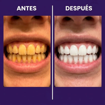 Tiras Blanqueadoras Estirables - Elimina Manchas y Tono Amarillo en 30 Minutos