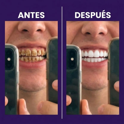 Tiras Blanqueadoras Estirables - Elimina Manchas y Tono Amarillo en 30 Minutos